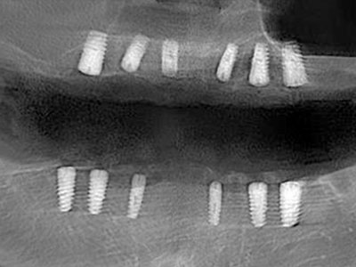 全牙列缺損修復(fù)病例