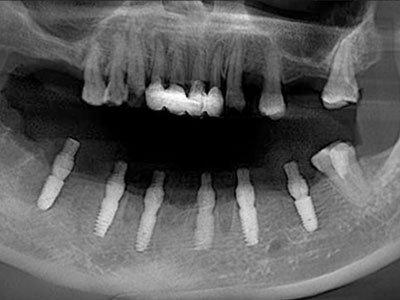 下半口修復(fù)病例