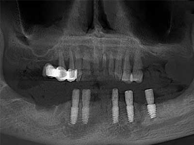 全牙列缺損下半口修復病例