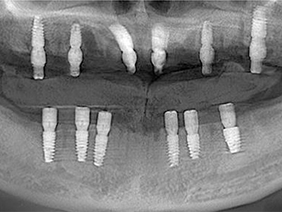 全口修復(fù)病例